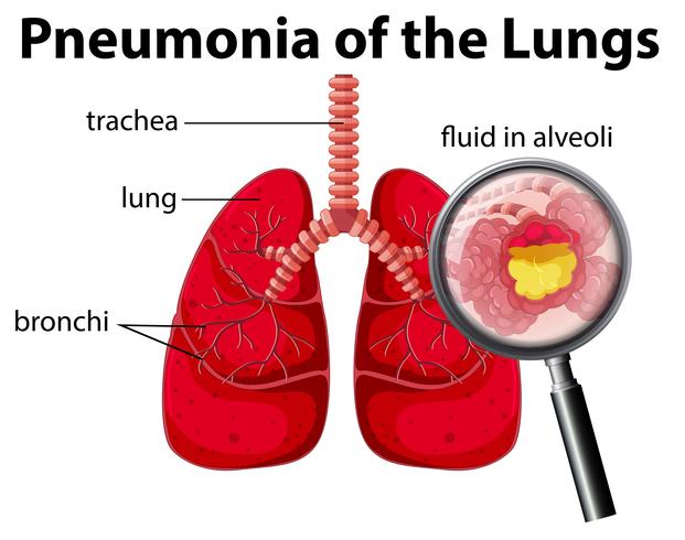 pneumonia