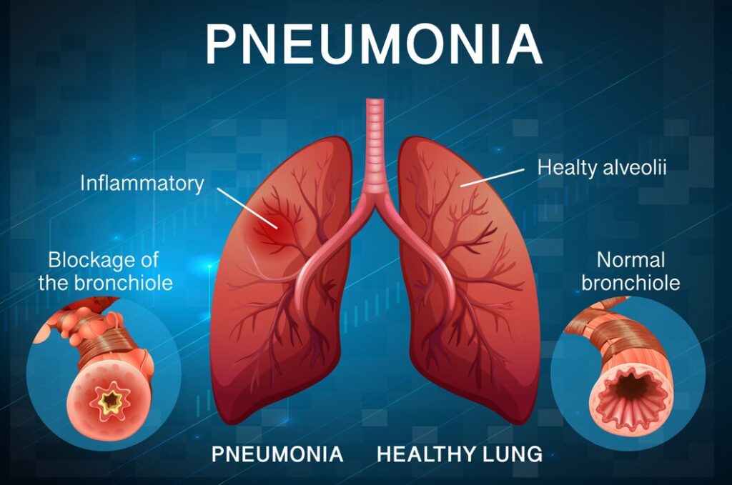 pneumonia-