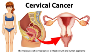 Cervical cancer